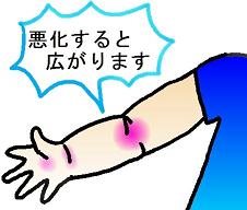 乳幼児の紅色汗疹